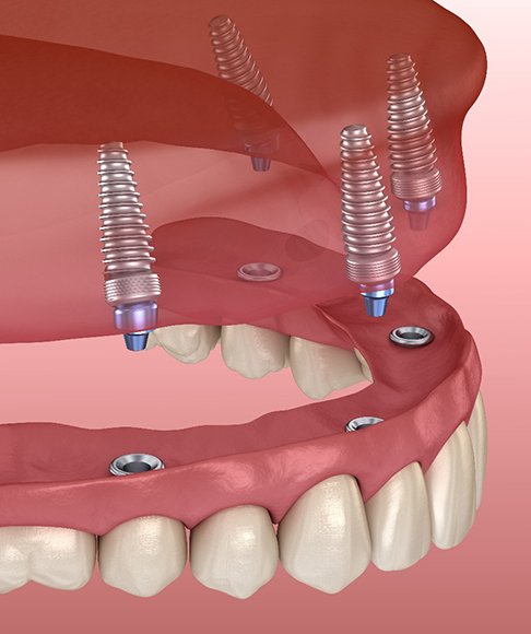 All-on-4 dental implants in Vero Beach, FL on the upper arch 