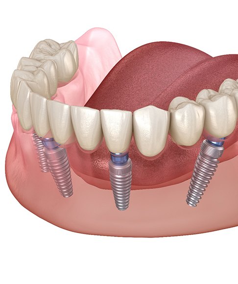 All-on-4 implants on the lower arch 
