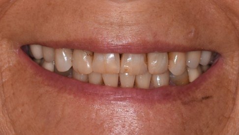 Yellowed decayed smile before dental treatment