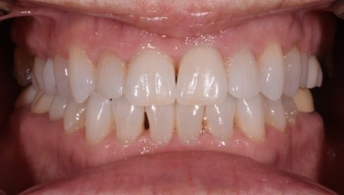 Flawlessly aligned teeth after clear braces treatment