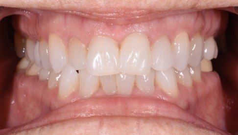 Overlapping teeth before clear braces treatment