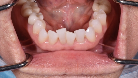 Crooked bottom teeth before clear braces treatment