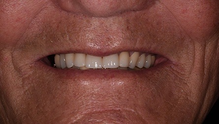 Aligned bottom teeth after 