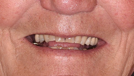 Teeth before 