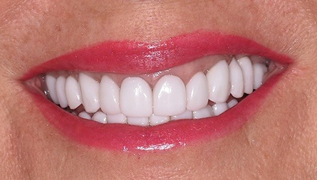 Aligned bottom teeth after clear braces treatment