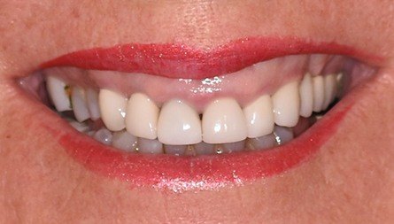Crooked bottom teeth before clear braces treatment