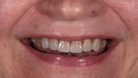 Aligned bottom teeth after clear braces treatment