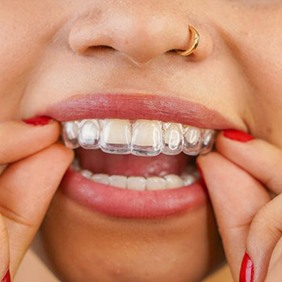 Close-up of woman placing clear aligner on her teeth