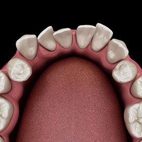 Illustration of crowded teeth viewed from above