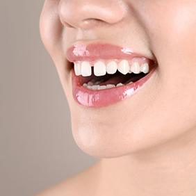Close-up of woman’s smile with a gap between the front teeth
