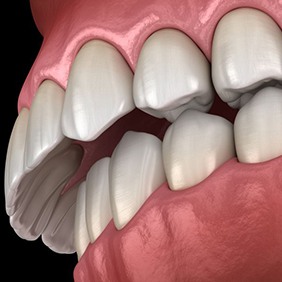 Illustration of an overbite against dark background