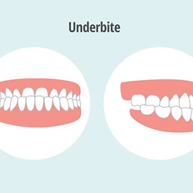 Illustration of underbite viewed from front and side