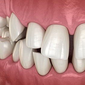 Close-up illustration of a crossbite