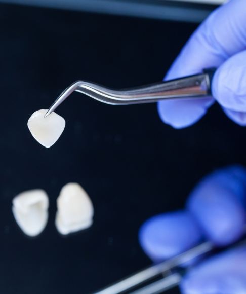 Porcelain veneer held by dental tools prior to placement