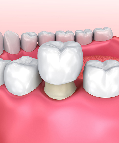 diagram of an Emax crown covering a tooth