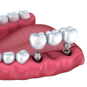 Animated smiling during dental implant supported fixed bridge placement