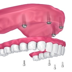 Animated smile during dental implant supported denture placement