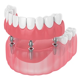 Digital illustration of implant dentures in Vero Beach