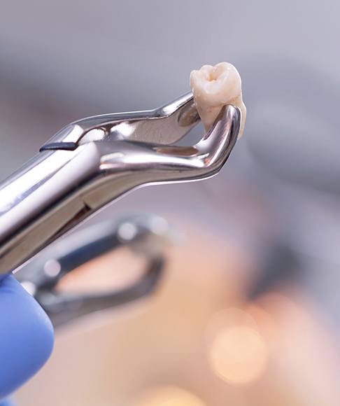 Close-up of a gloved hand holding an extracted tooth in forceps