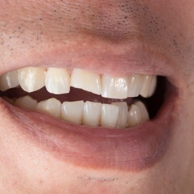 Smile with chipped front tooth