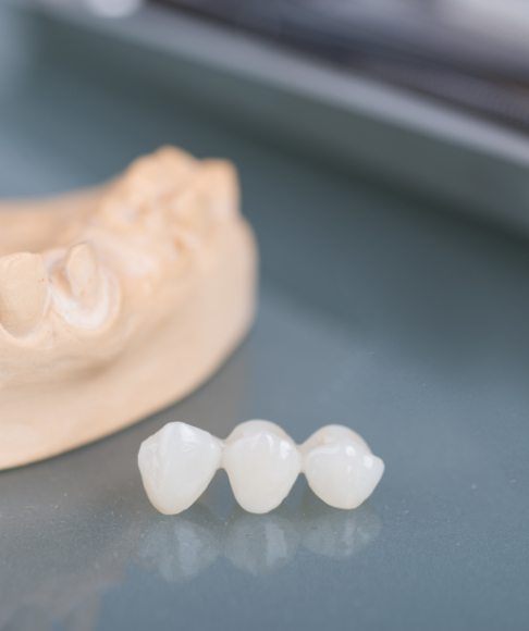 Model smile with dental bridge used to replace missing teeth