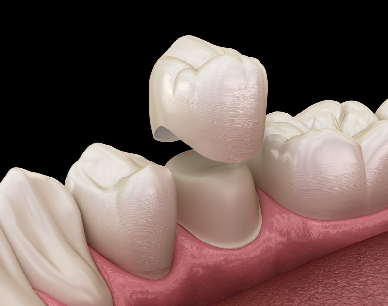 3-D model of a dental crown on a tooth